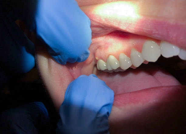 Best Emergency Wisdom Tooth Extraction in East Ithaca, NY