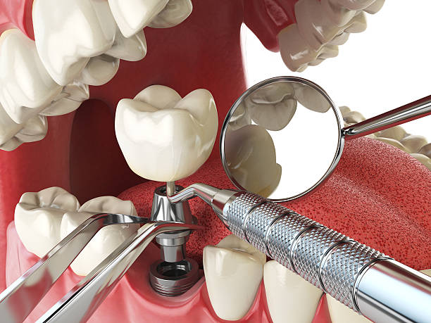 Best Lost Filling or Crown Replacement in East Ithaca, NY